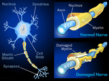 what is nerve damage? image of regular and damaged nerves